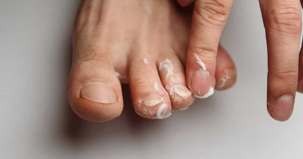 does antifungal cream work on athletes foot